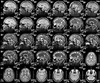MRI scans through a human head showing a healthy brain